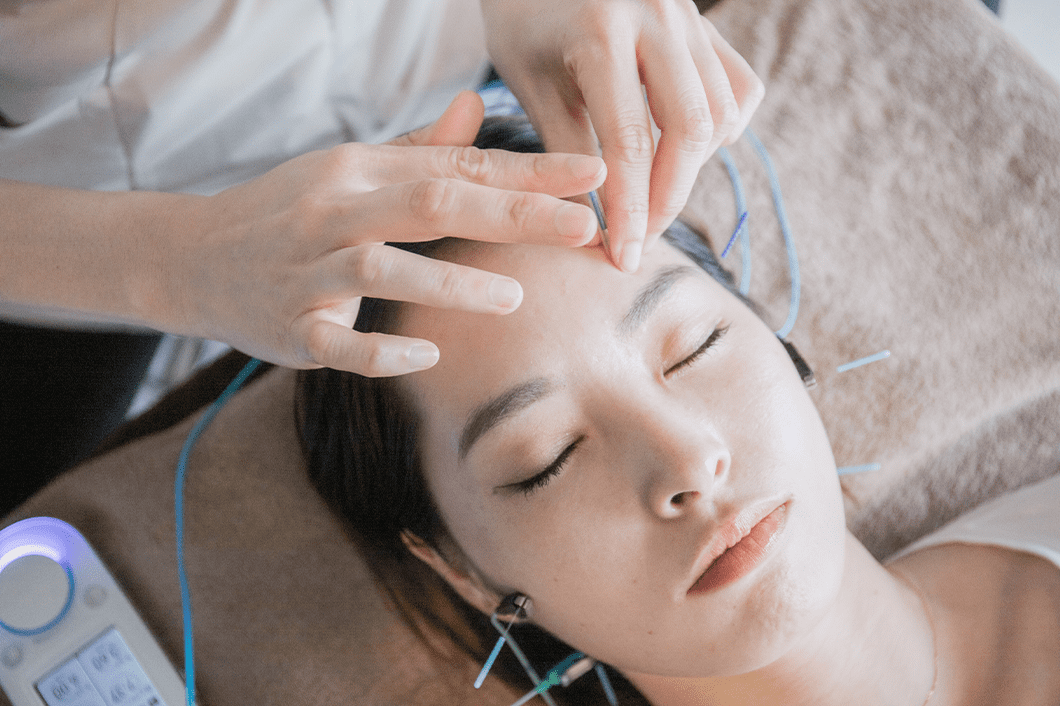 美容鍼について
