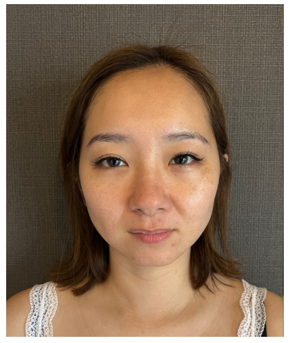 ビフォー